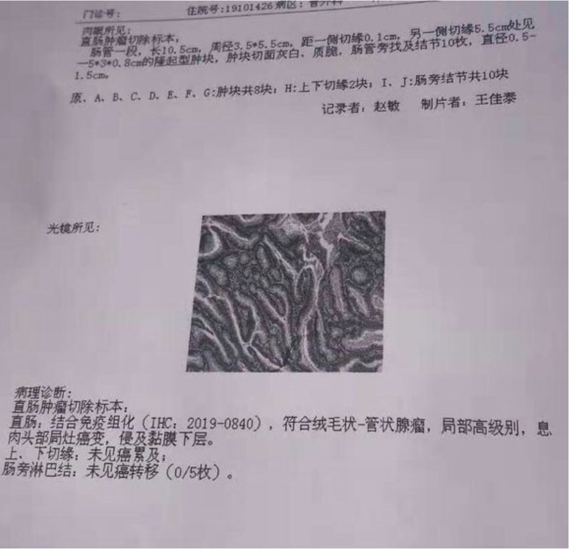 肠镜提示ca